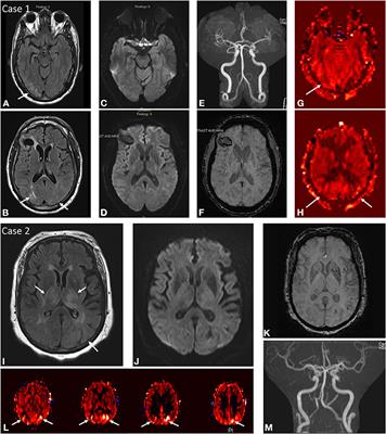 Added Value of Arterial Spin Labeling in Detecting Posterior Reversible Encephalopathy Syndrome as a Stroke Mimic on Baseline Neuroimaging: A Single Center Experience